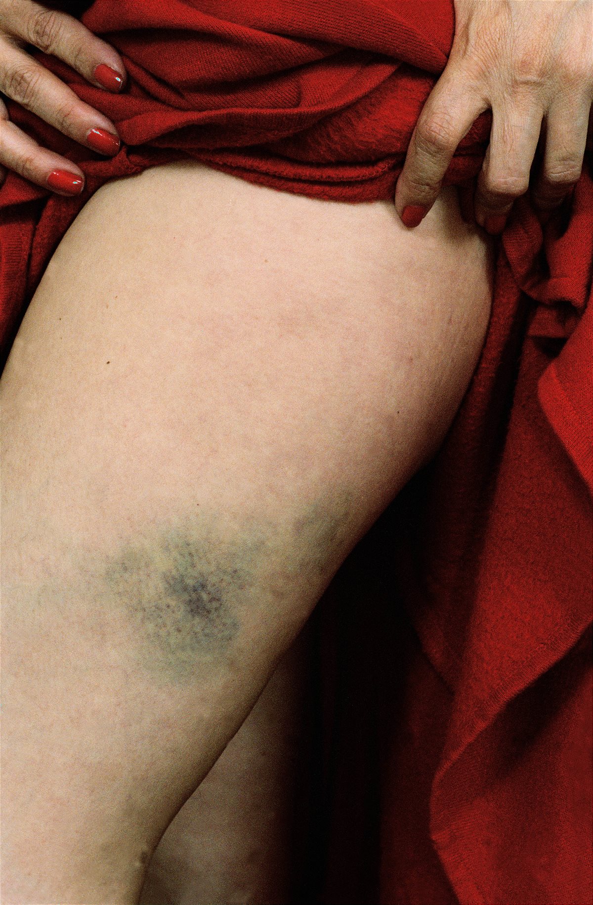 Susan Meiselas_Bruised woman victim of domestic violence. San Francisco, USA, 1992_C_Susan Meiselas_Magnum Photos